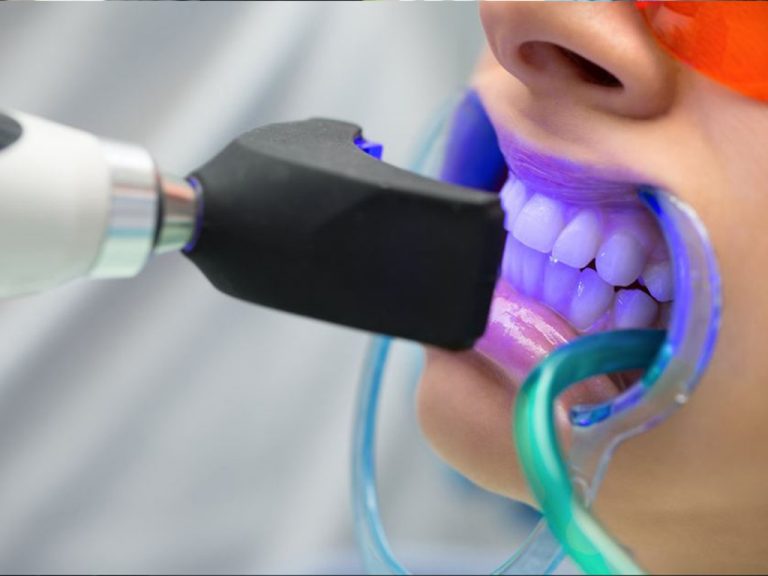 Lighten the colour of your teeth with Teeth Whitening